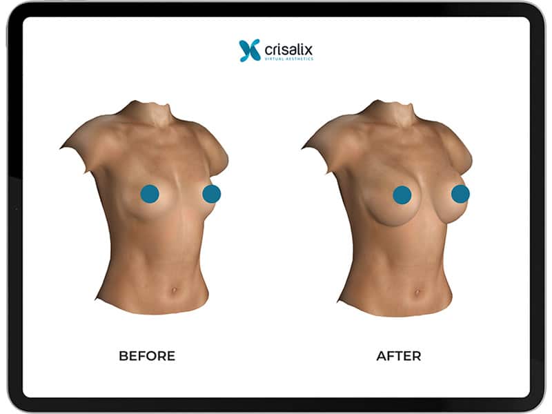 3D Simulation für Brustvergrößerungen und andere Brust OPs