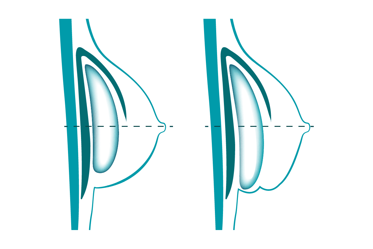 Nach der Brust OP: Double Bubble Phänomen