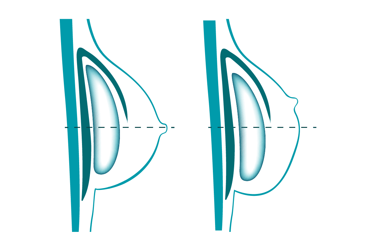 Bottoming Out Symptmome - Wie erkennt man ein Bottoming Out nach der Brust OP?