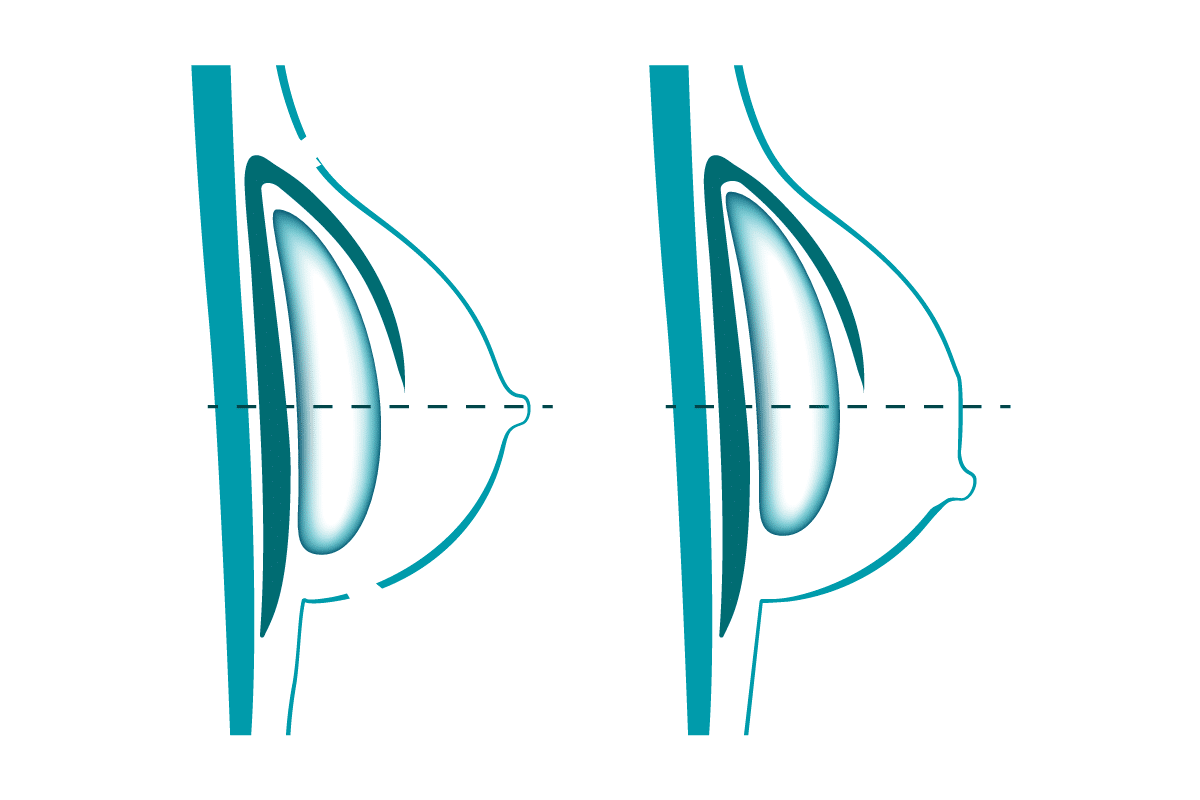 Komplikation mit Brustimplantat: Wie sieht eine Waterfall Deformity aus?